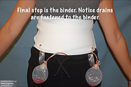 Can I keep wearing an abdominal binder after tummy tuck? Or is a