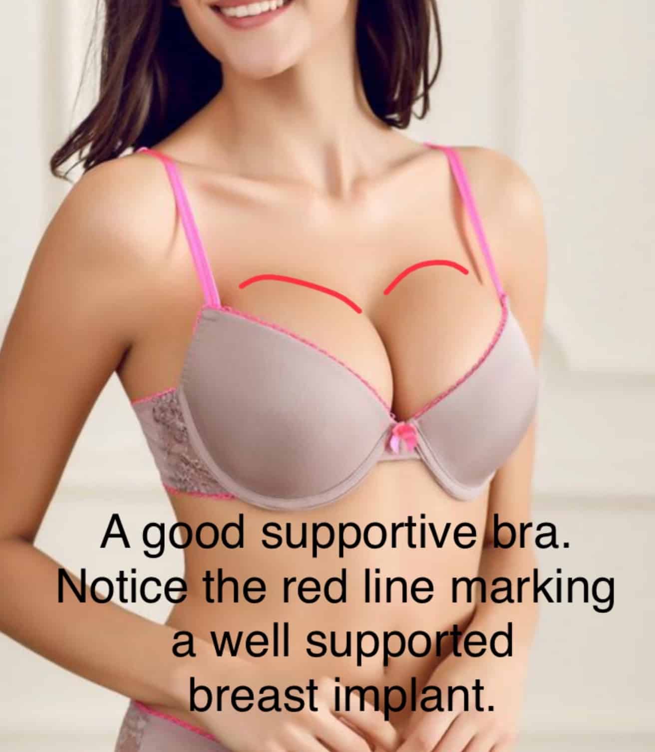 First Bra After Breast Augmentation Help : r/ABraThatFits