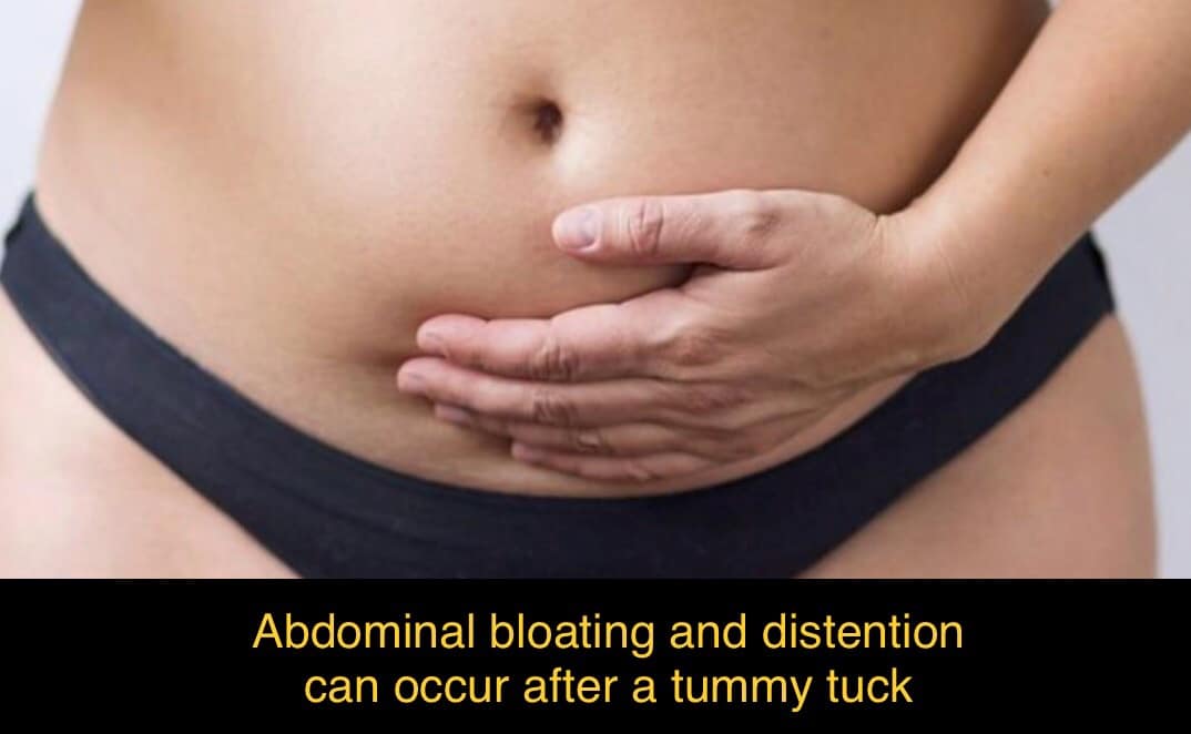 Tummy Tuck Recovery : Less Common Signs and Symptoms Experienced - Dr.  Chris Saunders MD