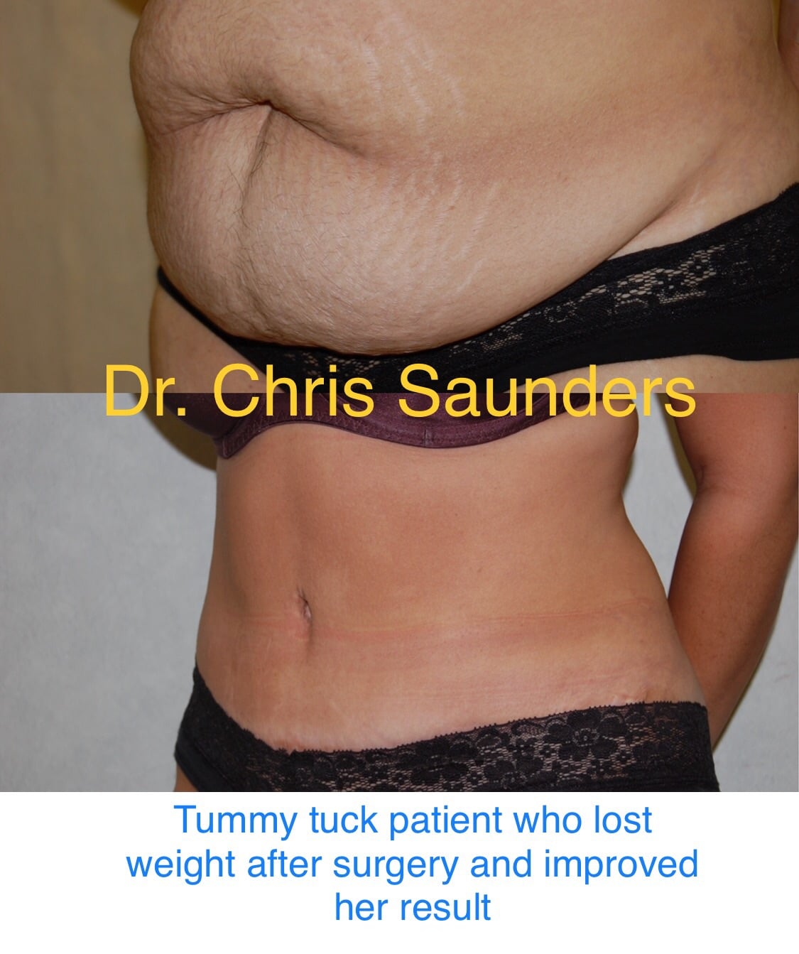 Tummy Tuck and Weight Loss: When is the Best Time to Lose Weight? - Dr.  Chris Saunders MD